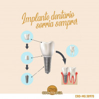 Implantes Dentários 